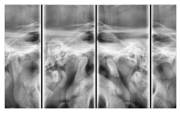 Radiografias de la ATM