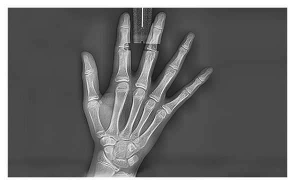 Radiograf�a Carpal