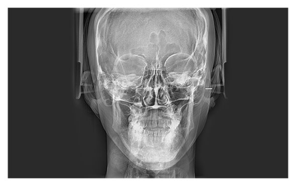 Radiograf�a Posteroanterior